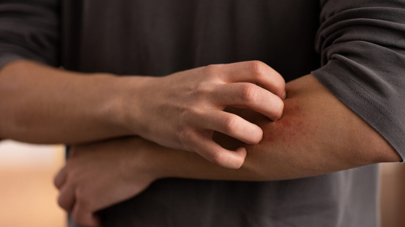 eczema démengeaison